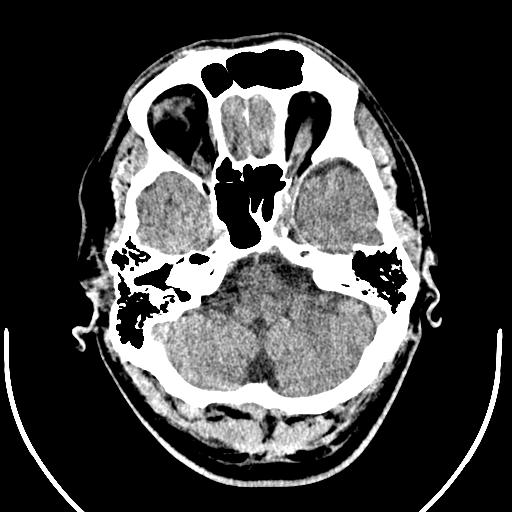 Anterior choroidal artery infarct (Radiopaedia 55106-61480 Axial non-contrast 9).jpg