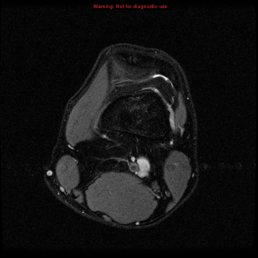 File:Anterior cruciate ligament injury - partial thickness tear (Radiopaedia 12176-12515 Axial PD 5).jpg