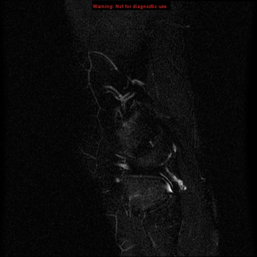 File:Anterior cruciate ligament injury - partial thickness tear (Radiopaedia 12176-12515 Sagittal T2 fat sat 17).jpg