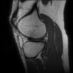 File:Anterior cruciate ligament rupture and posteromedial corner injury (Radiopaedia 67338-76723 Sagittal PD 125).jpg