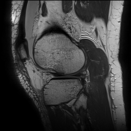 Anterior cruciate ligament rupture with Segond fracture (Radiopaedia 69043-78806 Sagittal PD 140).jpg