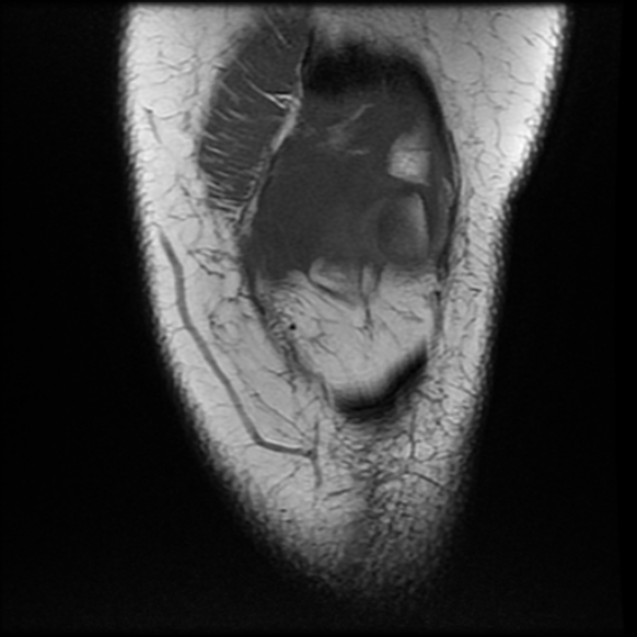 File:Anterior cruciate ligament tear, Wrisberg rip and bucket-handle tear of medial meniscus (Radiopaedia 75872-87266 Coronal T1 6).jpg