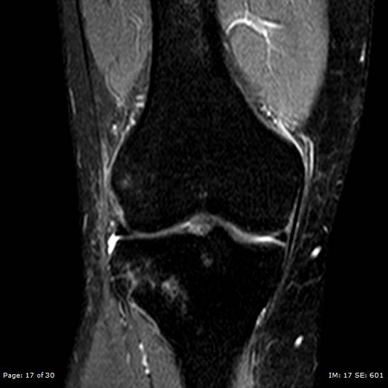 File:Anterior cruciate ligament tear (Radiopaedia 70783-80964 Coronal STIR 17).jpg