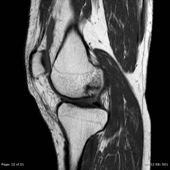 File:Anterior cruciate ligament tear (Radiopaedia 70783-80964 Sagittal T1 12).jpg
