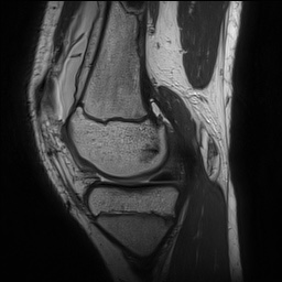 File:Anterior cruciate ligament tear - pediatric (Radiopaedia 62152-70260 Sagittal PD 64).jpg
