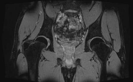 Anterior inferior iliac spine avulsion fracture (Radiopaedia 81312-95000 G 34).jpg