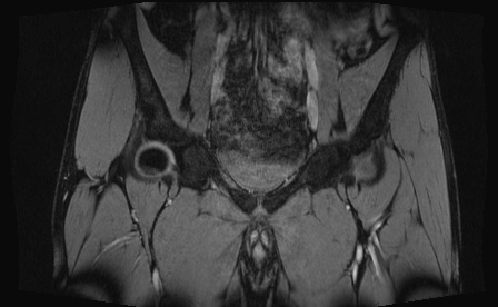 Anterior inferior iliac spine avulsion fracture (Radiopaedia 81312-95000 G 67).jpg