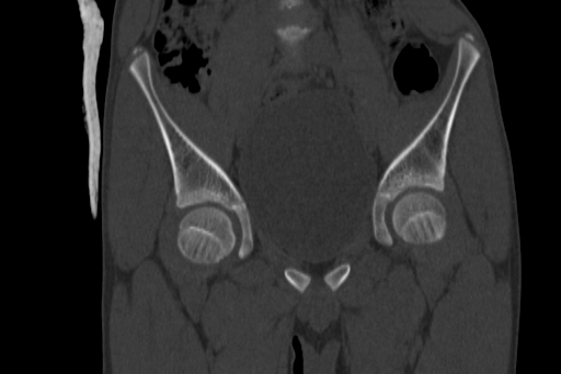 Anterior inferior iliac spine avulsion injury (Radiopaedia 88666-105376 Coronal bone window 29).jpg