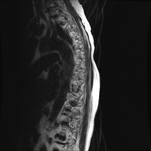 File:Anterior spinal artery syndrome (Radiopaedia 46335-50750 C 9).png