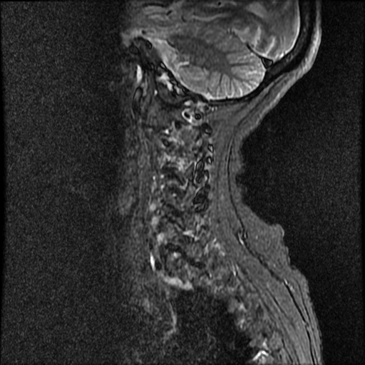 File:Anterior spinal artery syndrome (Radiopaedia 46335-50750 Sagittal STIR 1).png