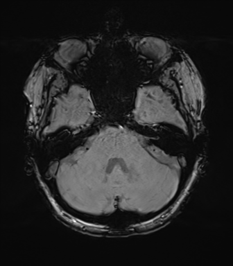 Anterior temporal lobe perivascular space (Radiopaedia 40946-43650 Axial SWI 21).png