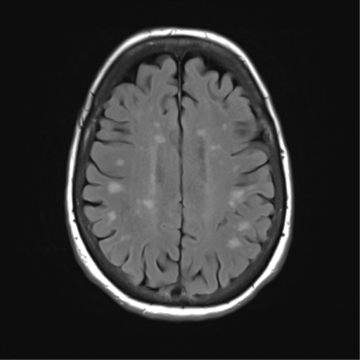 File:Anterior temporal pole cysts (Radiopaedia 46629-51102 Axial FLAIR 19).png