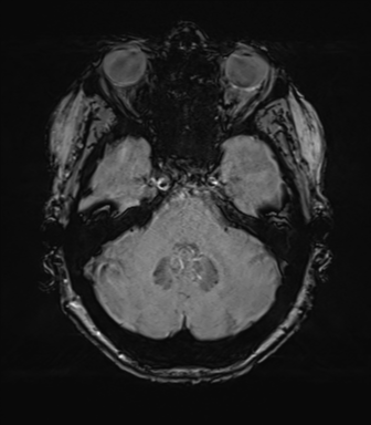 Anterior temporal pole cysts (Radiopaedia 46629-51102 Axial SWI 24).png