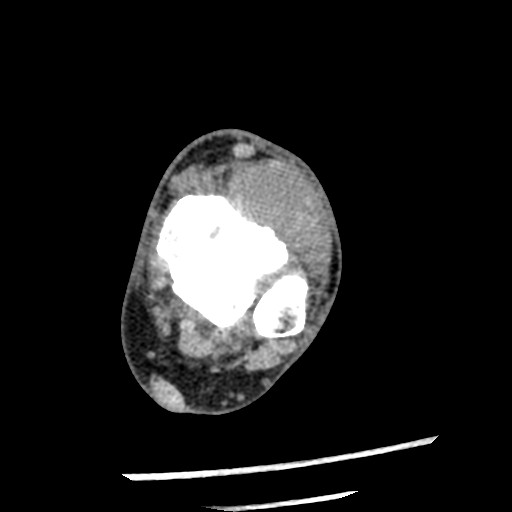 Anterior tibial artery false aneurysm (Radiopaedia 88984-105809 A 111).jpg