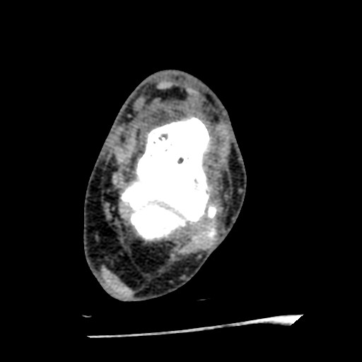 Anterior tibial artery false aneurysm (Radiopaedia 88984-105809 A 147).jpg