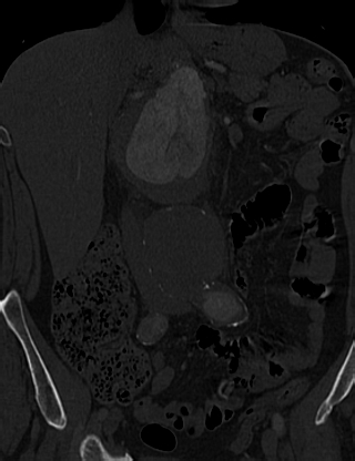 File:Anterior vertebral scalloping (abdominal aortic aneurysm) (Radiopaedia 66744-76067 Coronal bone window 14).jpg