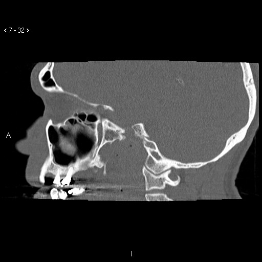 File:Antrochoanal Polyp (Radiopaedia 70510-80631 Sagittal bone window 22).jpg