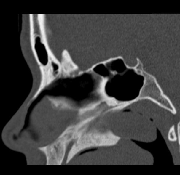 Antrochoanal polyp (Radiopaedia 33984-35202 Sagittal bone window 42).jpg