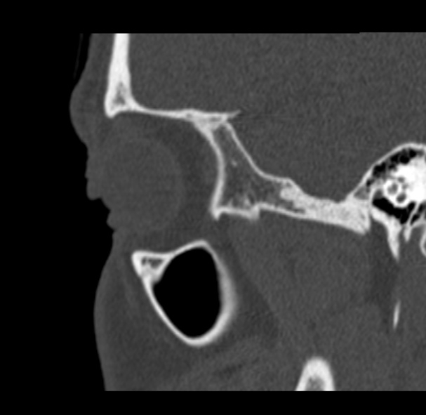 Antrochoanal polyp (Radiopaedia 33984-35202 Sagittal bone window 72).jpg