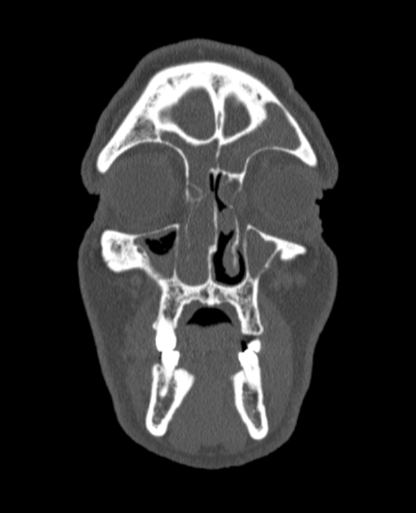Antrochoanal polyp (Radiopaedia 79011-92169 Coronal bone window 68).jpg