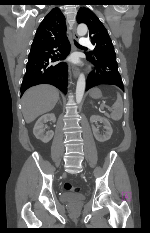 Aortectomy and axillary-bifemoral bypass (Radiopaedia 28303-28545 C 57).jpg