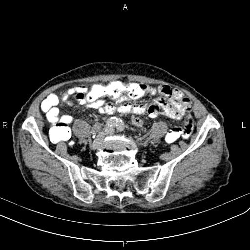 Aortic aneurysm and Lemmel syndrome (Radiopaedia 86499-102554 Axial C+ delayed 56).jpg