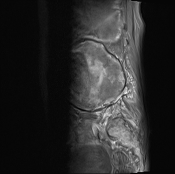 File:Aortic aneurysm with spinal destruction (Radiopaedia 42301-45409 Sagittal T1 fat sat 17).jpg