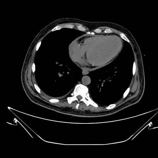 Aortic arch aneurysm (Radiopaedia 84109-99365 Axial non-contrast 192).jpg
