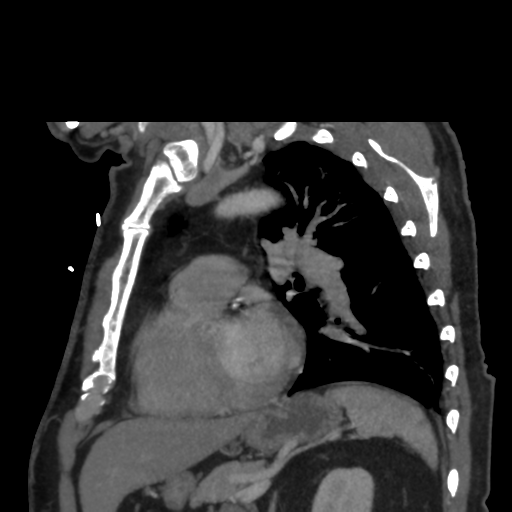File:Aortic dissection- Stanford A (Radiopaedia 37759-39664 D 24).png