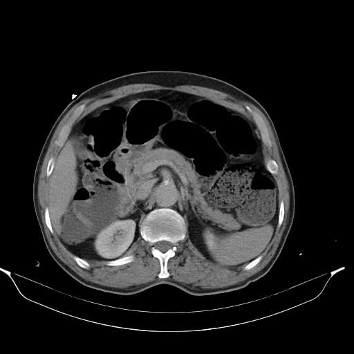 Aortic dissection- Stanford type A (Radiopaedia 22085-22085 Axial C+ delayed 17).jpg