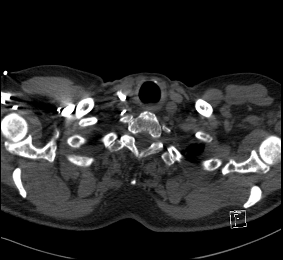 Aortic dissection (CTPA) (Radiopaedia 75506-86751 Axial C+ CTPA 7).jpg