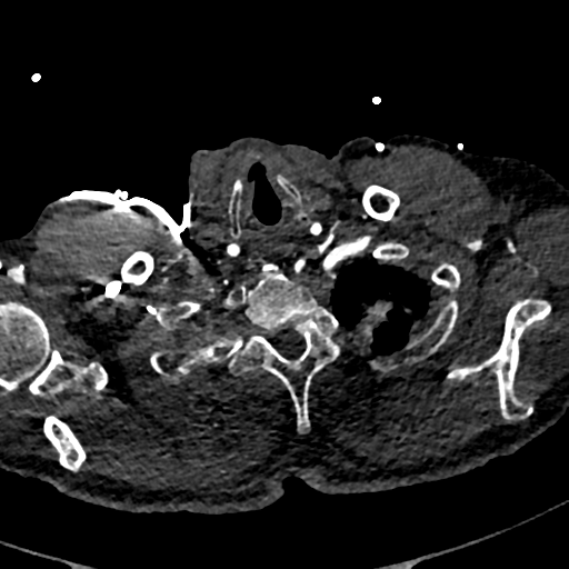 File:Aortic dissection - DeBakey type II (Radiopaedia 64302-73082 A 8).png