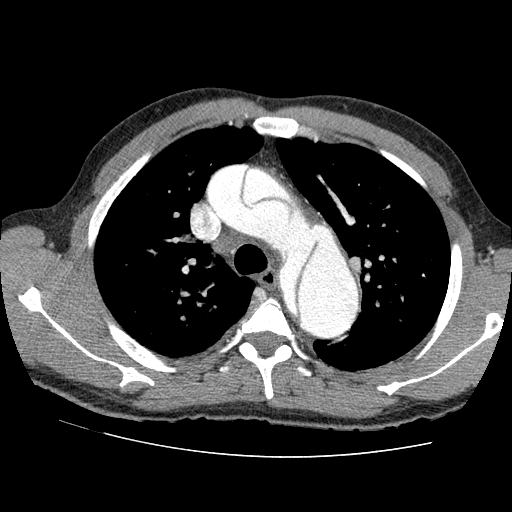 Aortic dissection - Stanford A -DeBakey I (Radiopaedia 28339-28587 B 19).jpg