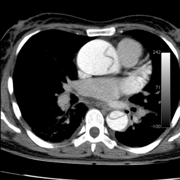 Aortic dissection - Stanford type A (Radiopaedia 29247-29659 A 41).jpg
