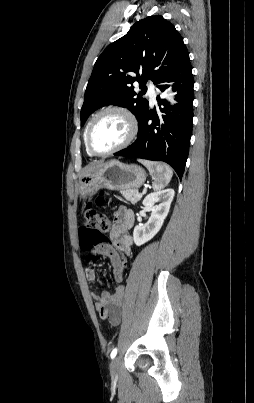 Aortic dissection - Stanford type A (Radiopaedia 83418-98500 B 72).jpg