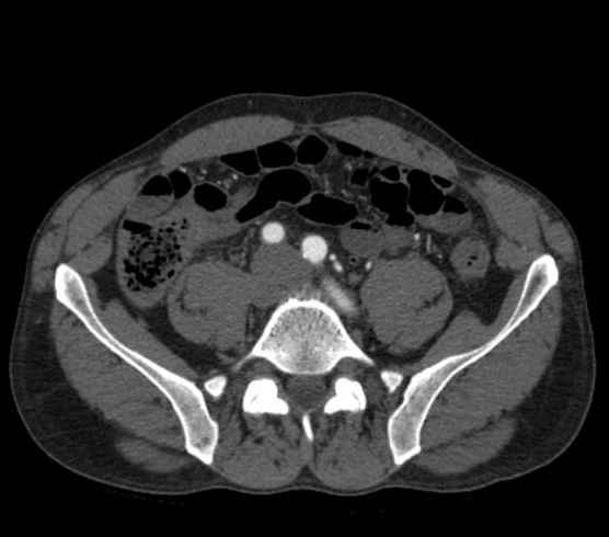 Aortic dissection - Stanford type B (Radiopaedia 73648-84437 A 205).jpg