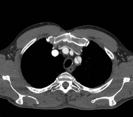 Aortic dissection - Stanford type B (Radiopaedia 73648-84437 A 9).jpg