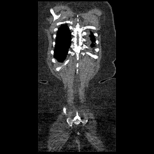 File:Aortic dissection - Stanford type B (Radiopaedia 88281-104910 B 83).jpg
