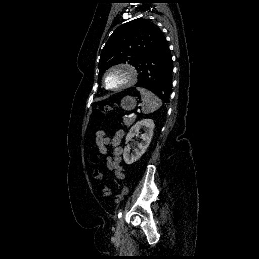 Aortic dissection - Stanford type B (Radiopaedia 88281-104910 C 66).jpg