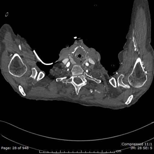 Aortic dissection with extension into aortic arch branches (Radiopaedia 64402-73204 B 28).jpg