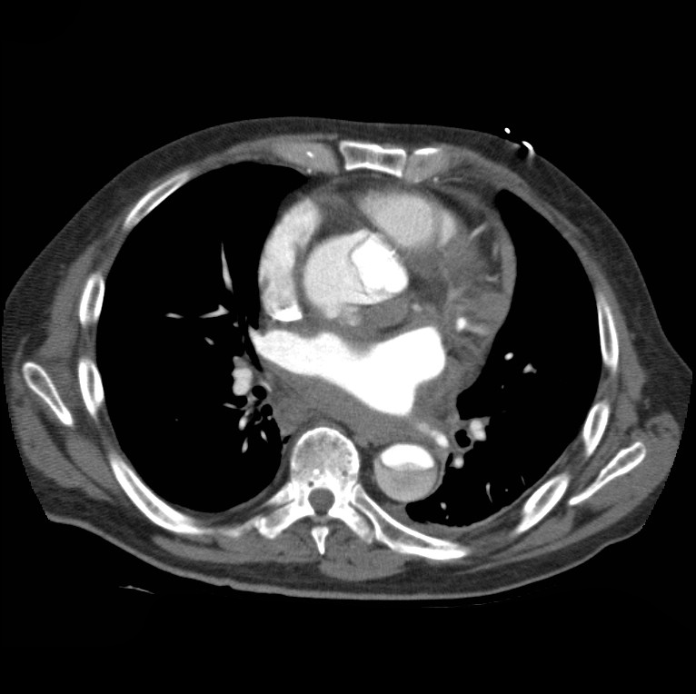 Aortic dissection with rupture into pericardium (Radiopaedia 12384-12647 A 31).jpg