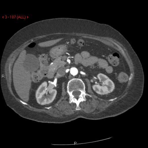 File:Aortic intramural hematoma (Radiopaedia 27746-28001 A 107).jpg