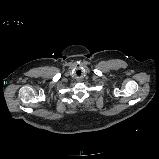 Aortic intramural hematoma (Radiopaedia 48463-53380 Axial non-contrast 8).jpg
