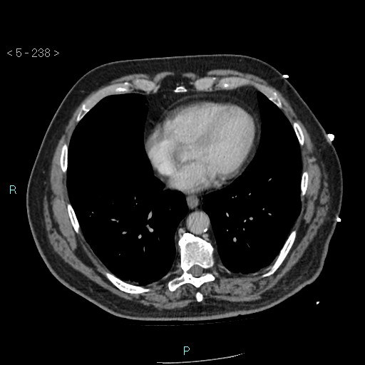 Aortic intramural hematoma (Radiopaedia 48463-53380 C 108).jpg