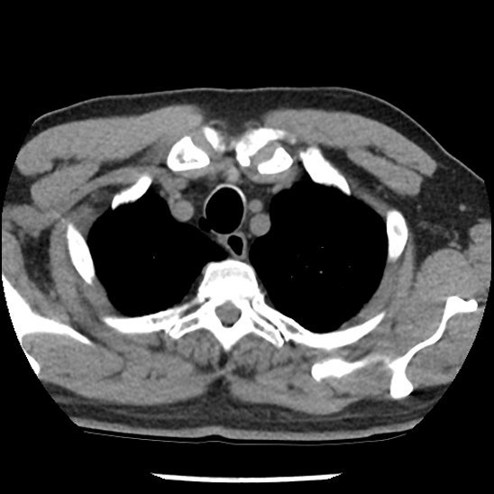 Aortic intramural hematoma (type B) (Radiopaedia 79323-92387 Axial non-contrast 5).jpg