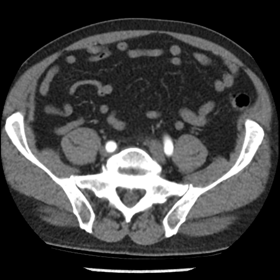 Aortic intramural hematoma (type B) (Radiopaedia 79323-92387 B 91).jpg