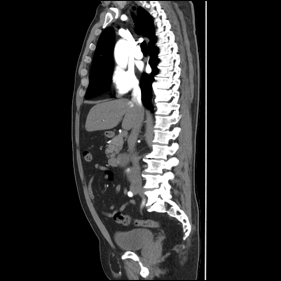 Aortic intramural hematoma (type B) (Radiopaedia 79323-92387 H 21).jpg
