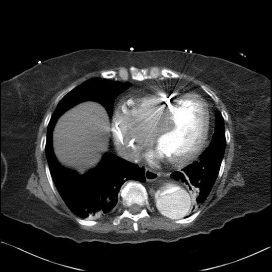 File:Aortic intramural hematoma with dissection and intramural blood pool (Radiopaedia 77373-89491 B 80).jpg
