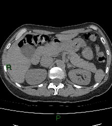 Aortic valve endocarditis (Radiopaedia 87209-103485 Axial non-contrast 101).jpg
