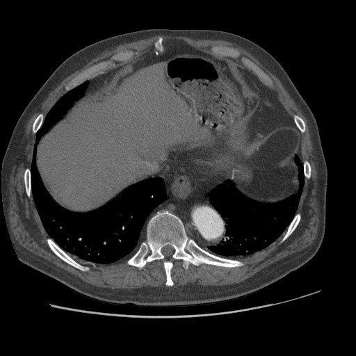 File:Aorto-coronary bypass graft aneurysms (Radiopaedia 40562-43157 A 102).png